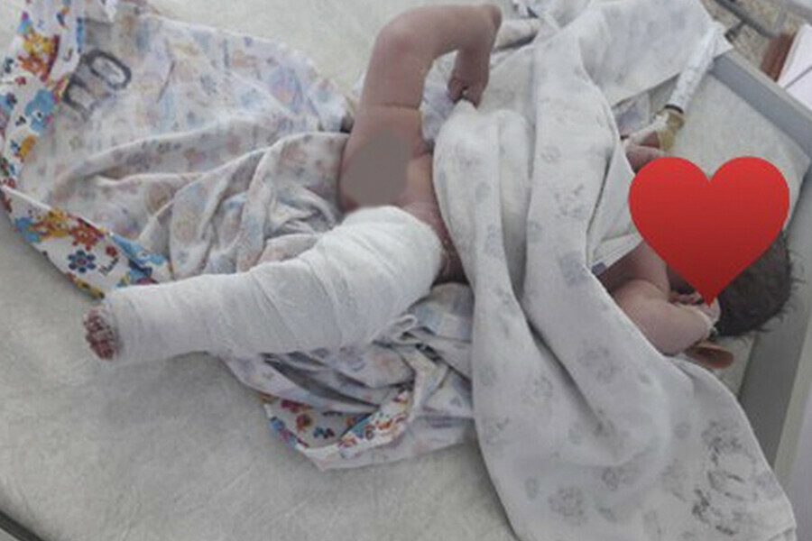 Амурские врачи вылечили младенца с редкой патологией фото