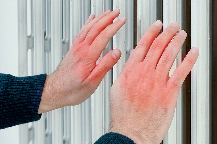 Ковидные пальцы новый кожный симптом коронавируса внесен в список диагностических