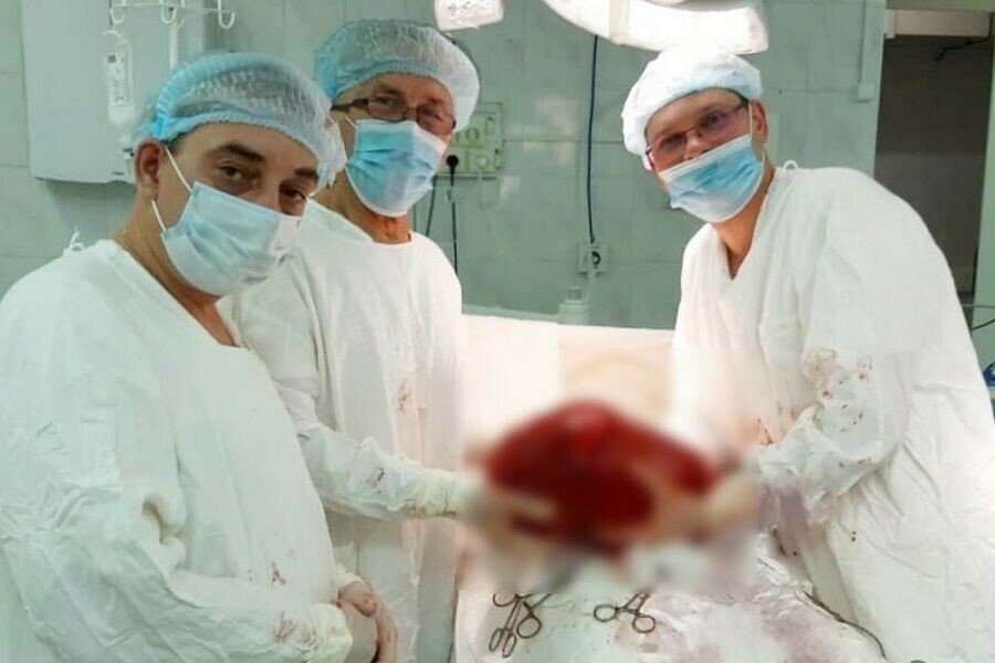 Врачи показали огромную 7килограммовую опухоль которую извлекли из тела россиянина 