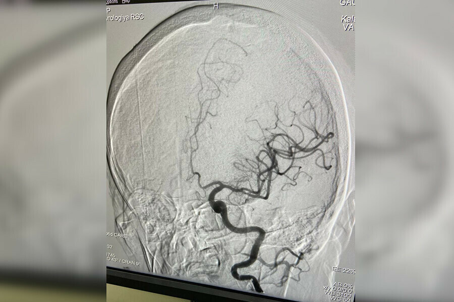 Современный вид лечения при ишемическом инсульте внедряют в Амурской областной больнице