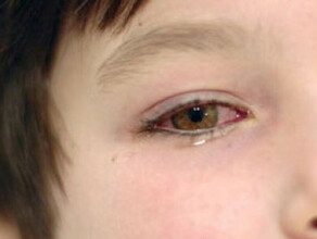 Адская боль в глазах родители детей получивших в школе ожоги глаз о их состоянии после ЧП 