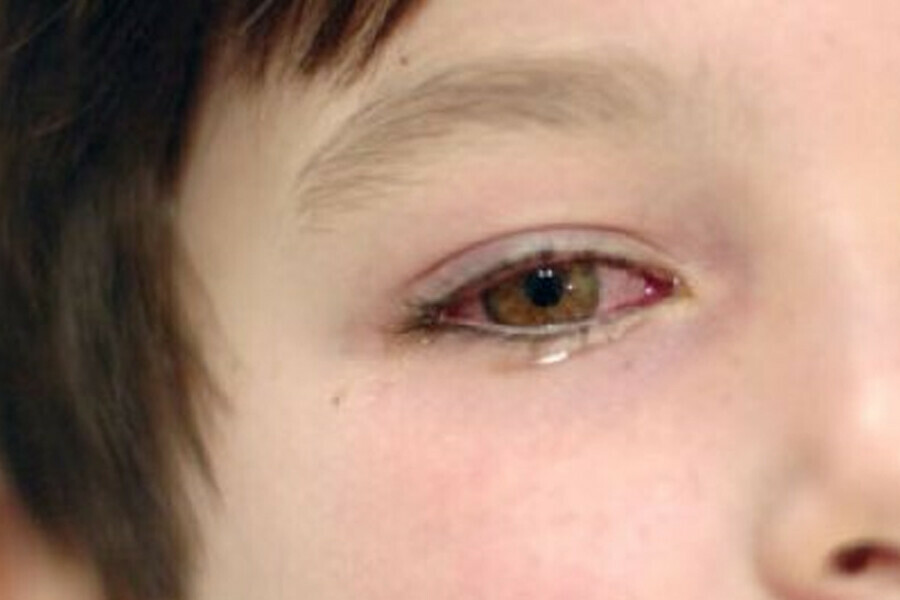Адская боль в глазах родители детей получивших в школе ожоги глаз о их состоянии после ЧП 