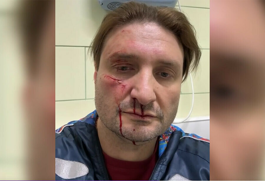 Дрессировщику Эдгарду Запашному тигр порвал лицо видео 18