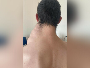 Уникальный медицинский случай в Хабаровске врачи прооперировали мужчину с гигантской опухолью фото видео 18