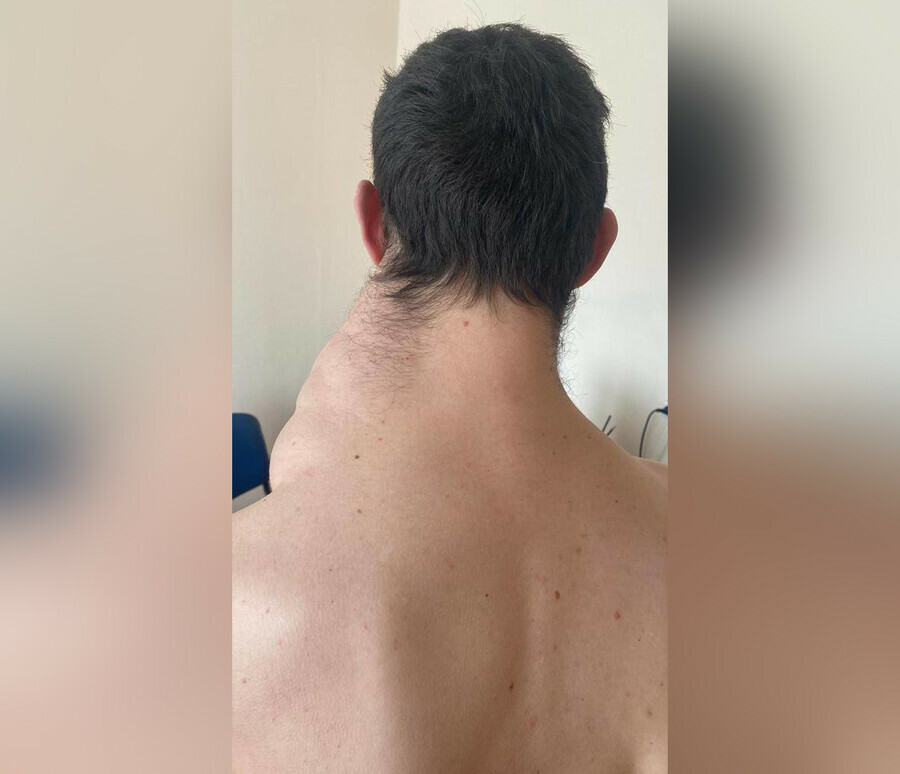 Уникальный медицинский случай в Хабаровске врачи прооперировали мужчину с гигантской опухолью фото видео 18