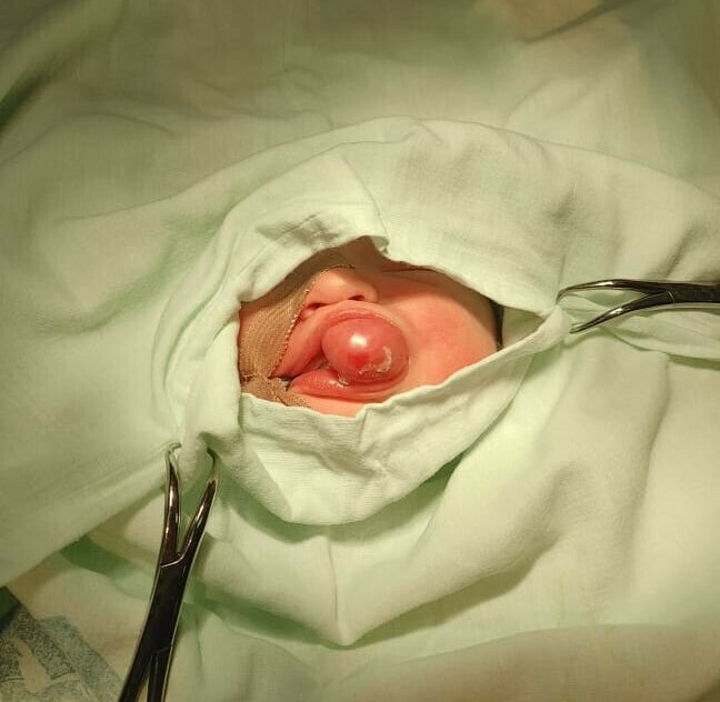 Новорожденного ребенка с редкой патологией прооперировали хирурги АОКБ
