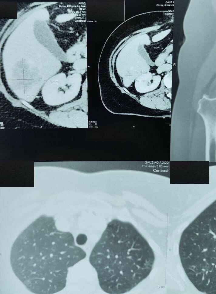 Амурские врачи виртуозно избавили пациентку от крупной раковой опухоли