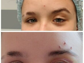Врачи АОДКБ освоили новую методику лечения заболевания которое раньше приходилось оперировать за пределами Приамурья