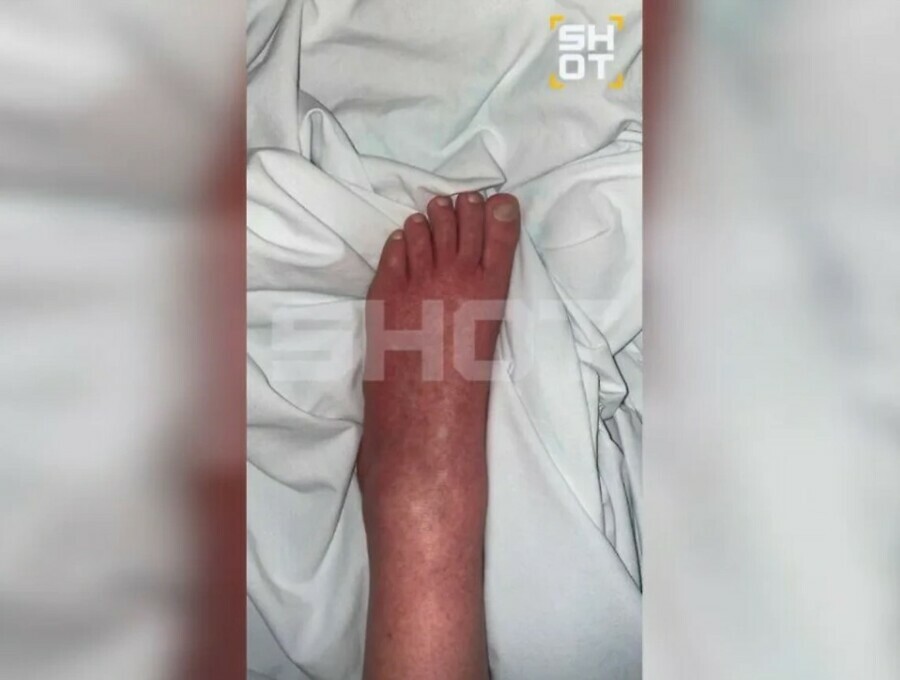 Кровь из носа галлюцинации и паралич на Бали туристы массово заражаются лихорадкой денге
