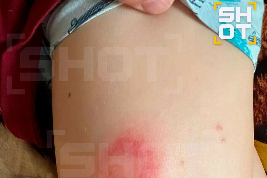 Российских туристов в Таиланде атаковали клещи Одна женщина заболела боррелиозом фото 18 