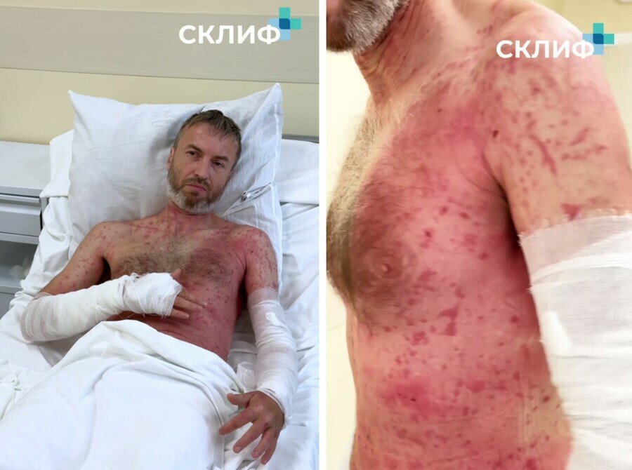 Мужчина получил ожоги 80  тела когда косил траву на даче