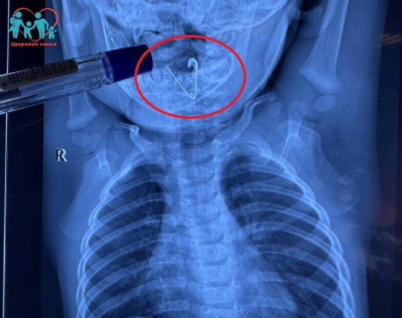 Восемь часов страха в Приморье 7месячный малыш проглотил открытую булавку