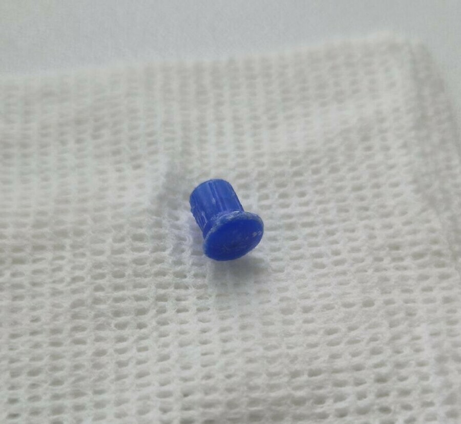 Школьник три недели прожил с колпачком от ручки в лёгких