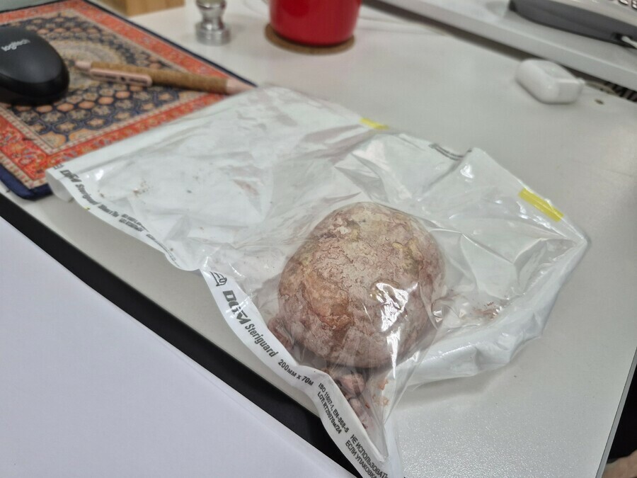 Килограммовый камень извлекли хирурги из живота 65летнего мужчины