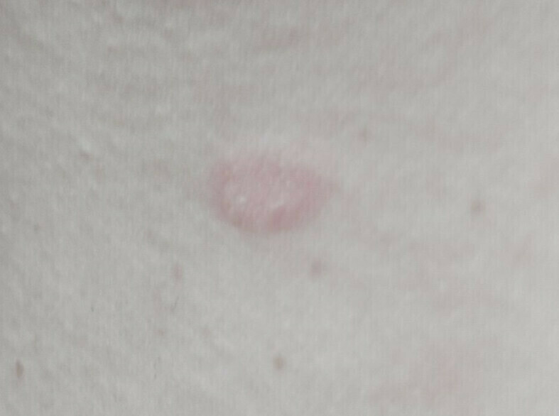 В мире признаки новой эпидемии по Европе стремительно распространяется опасный генитальный супергрибок