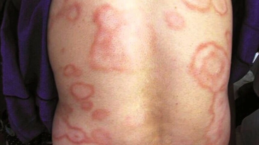 Женщина привезла из ЮгоВосточной Азии проказу