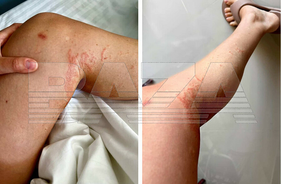 Россиянка пострадала от укусов ядовитого морского животного на Пхукете