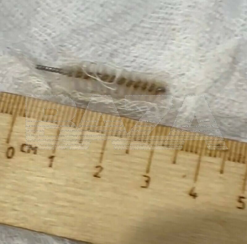 Врач забыл в теле пациентки ёршик