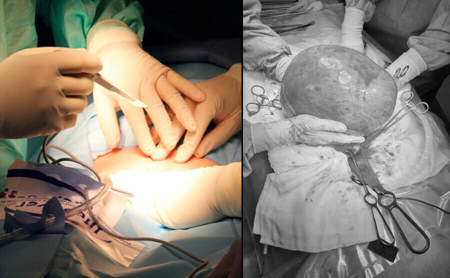 Такое не вырастает за месяц или год Дальневосточнице удалили огромную опухоль