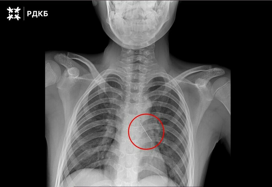 Ребенка вдохнувшего булавку спасли хирурги