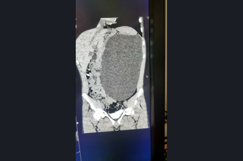 У 17летнего парня почка раздулась до размеров 5литровой бутылки и могла лопнуть в любой момент