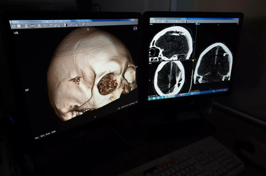 Врачи спасли пациента который сутки ходил с пулей в голове