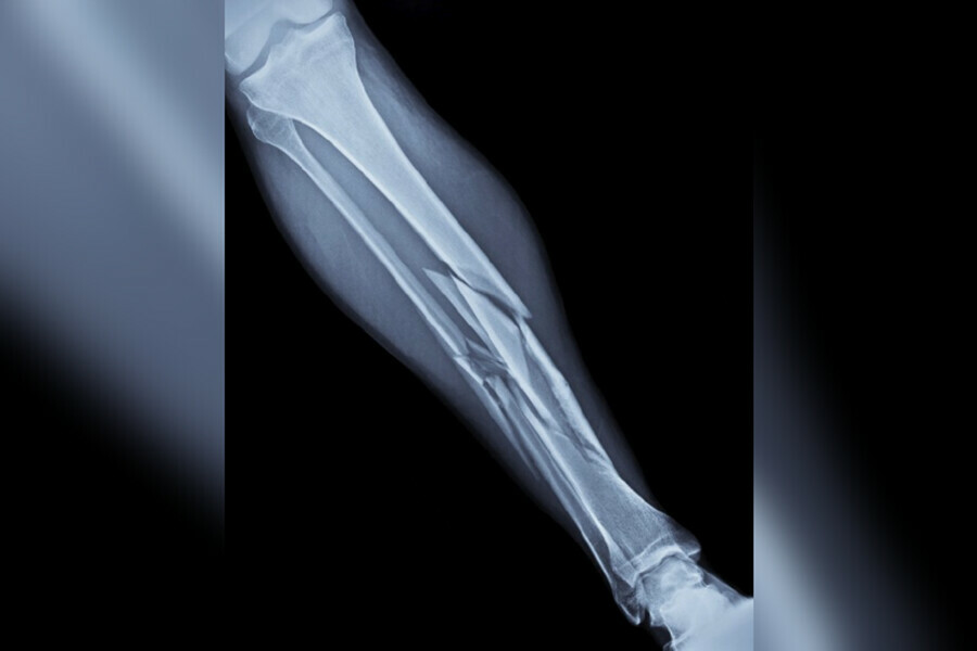 Тяжелую травму получил монтажник на строительной площадке Амурского ГХК