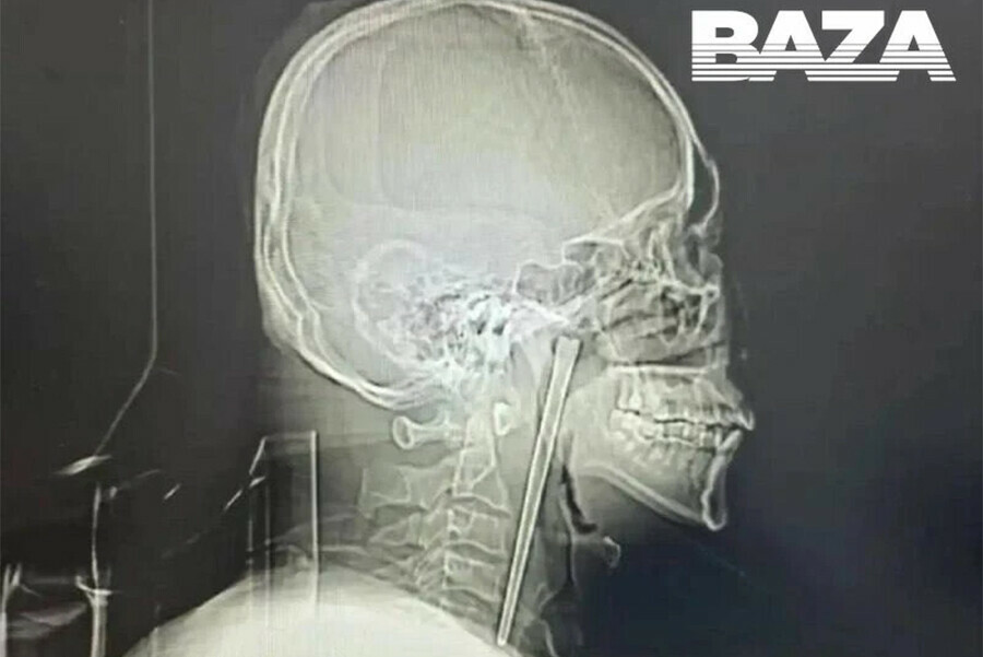 Китаец проглотил столовый прибор и жил с ним восемь лет