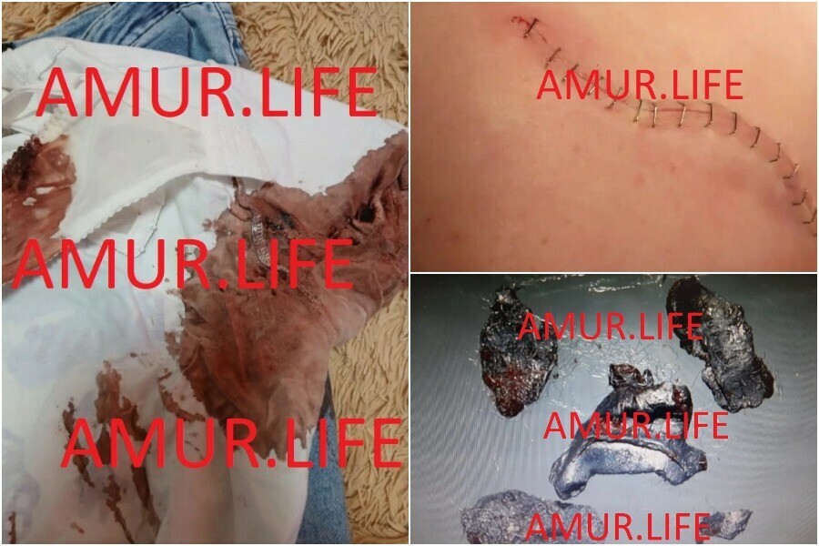 Ребенку сделали уже три операции школьница которую в Свободном ранил из ружья бизнесмен до сих пор не оправилась от случившегося