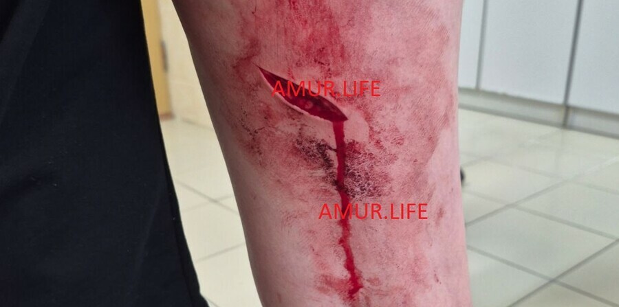 В Амурской области школьница пропорола однокласснику ногу подошвой с лезвием фото