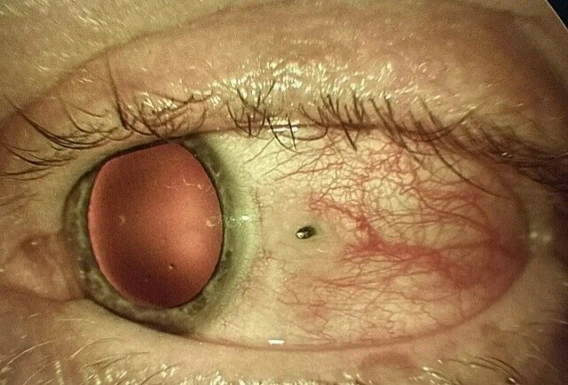 Дальневосточные врачи спасли мужчину с металлической занозой в глазу