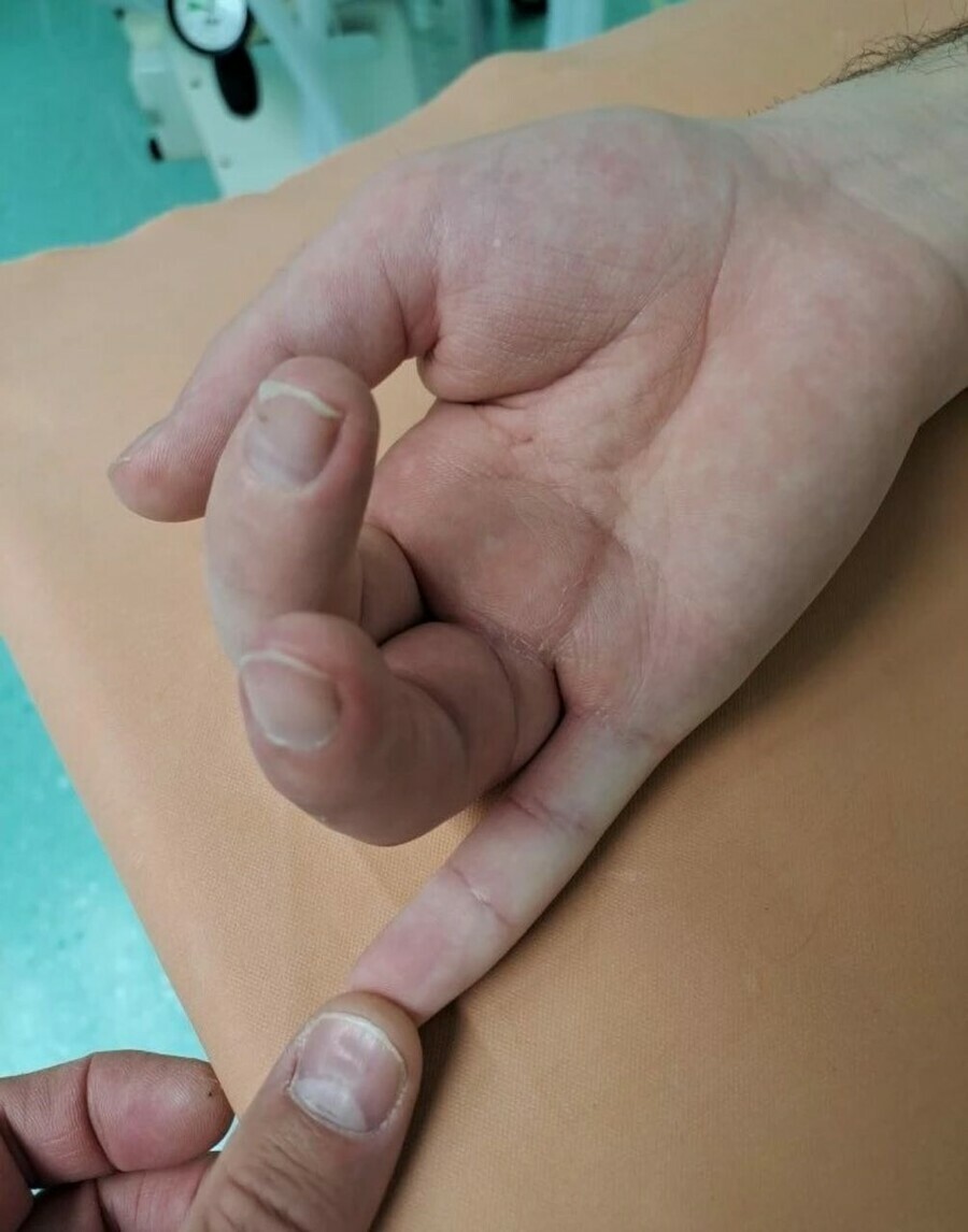 В Благовещенске хирурги ювелирно собрали пациенту новый палец вместо отрезанного пилой