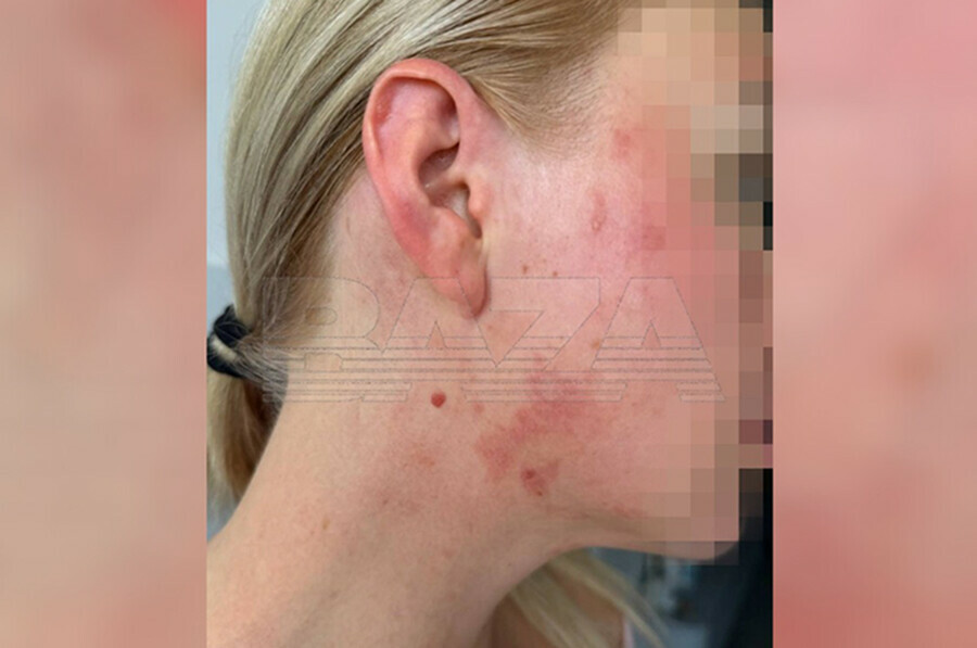 Жжение покраснение и отеки ядовитые насекомые атакуют туристов во Вьетнаме