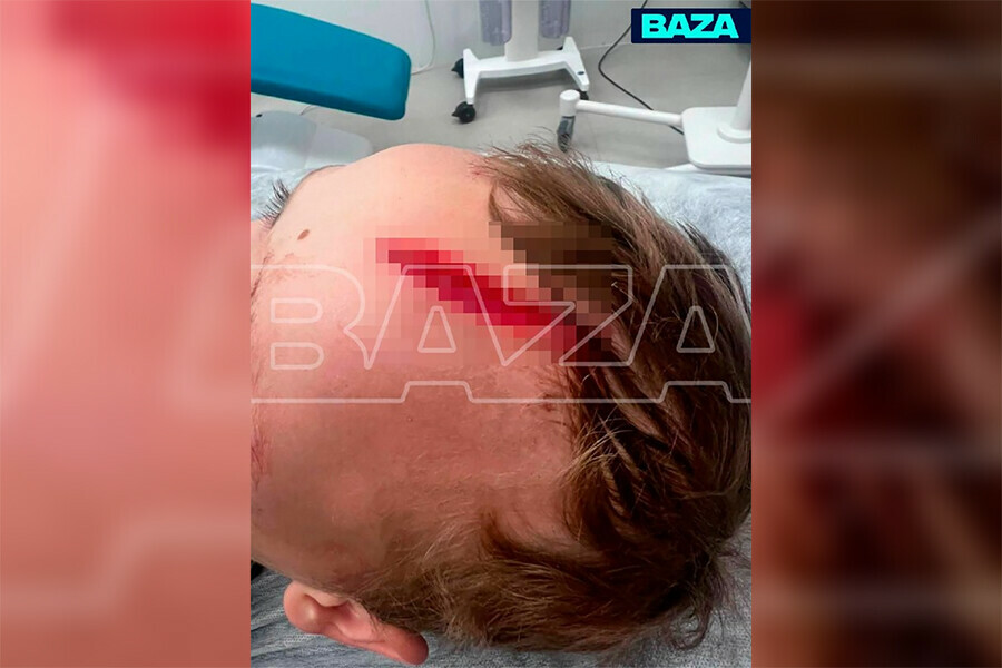 Внука писательницы Донцовой едва не загрызла домашняя акитаину