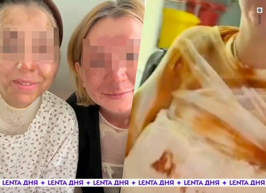 Еще одна фобия подруги получили большие ожоги после взрыва скороварки