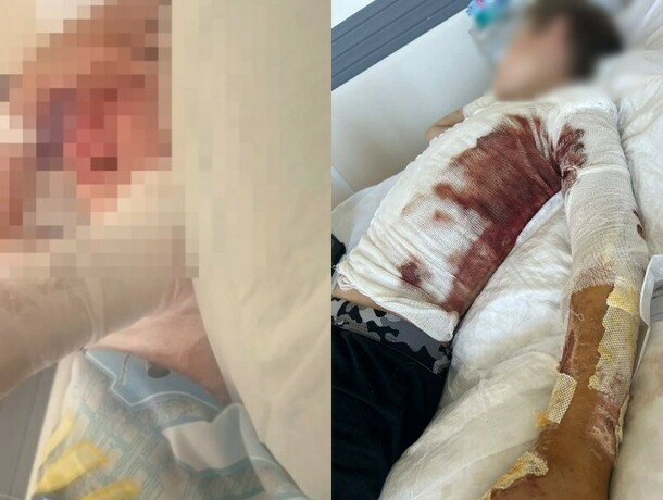 Он стоял и смеялся над тем как горит мой ребенок 10летний мальчик получил тяжелые ожоги после поджога канистры с бензином в Благовещенске фото 