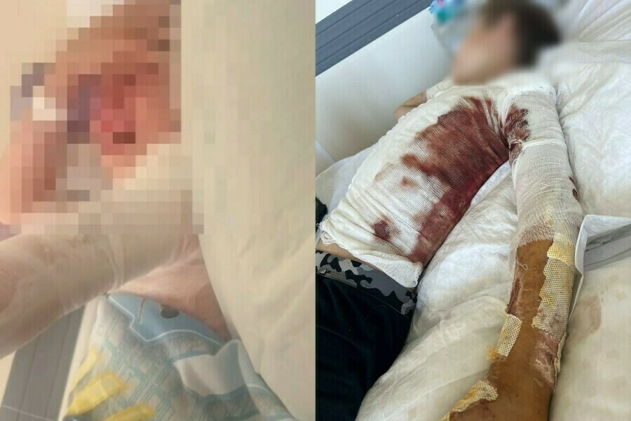 О мальчике который получил тяжелые ожоги в Благовещенске доложат главе Следкома России